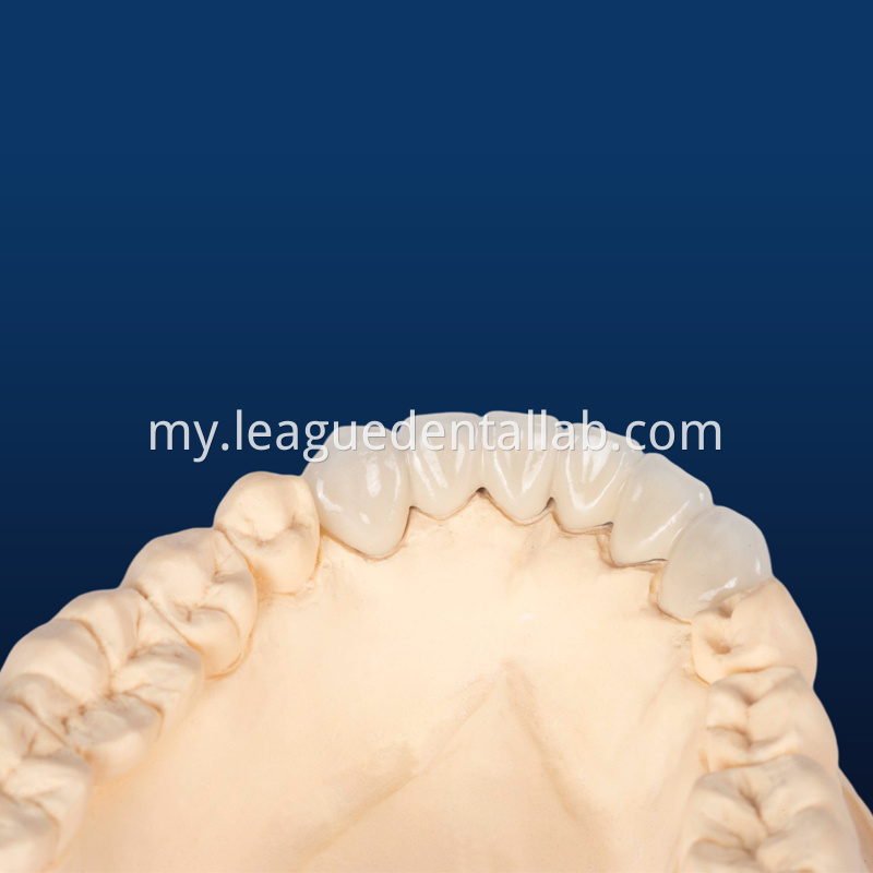 IPS Empress,Emax Onlay,Emax onlay,Emax Veneer,Lithium disilicate